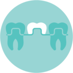 dental bridge